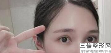 做开眼角手术会有疤吗，开眼角手术的疤痕多久能恢复正常