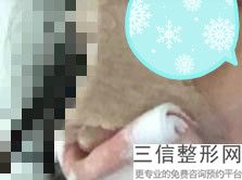 做隆鼻大概要多少费用,隆鼻一般要多少费用