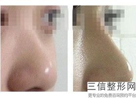 做隆鼻手术需要多长时间，隆鼻手术大概需要多长时间