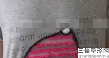 做隆胸手术哪个医院比较好，做隆胸手术良好的医院