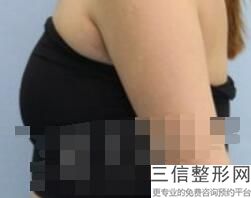 做隆胸手术哪个医院比较好，做隆胸手术良好的医院