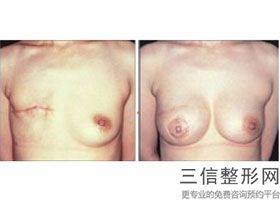 做隆胸手术那个医院比较好，做隆胸手术良好的医院