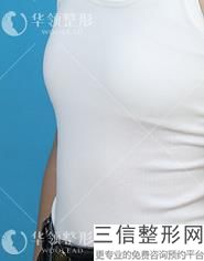 做隆胸手术需要多少钱，隆胸手术大概要多少钱