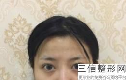 做埋线双眼皮好不好说说，埋线双眼皮好不好