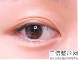 做埋线双眼皮会不会开，做完埋线双眼皮还可以开眼角吗