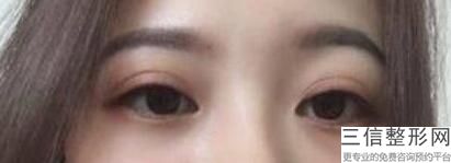 做埋线双眼皮疼不疼，埋线双眼皮做完疼不疼
