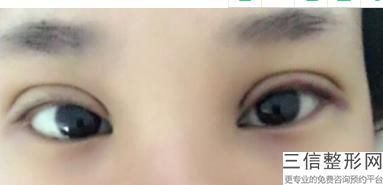 做祛除眼袋手术多少钱,祛眼袋手术的多钱