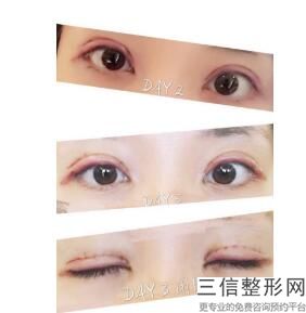 做去眼袋大概多少钱,做去眼袋一般多少钱