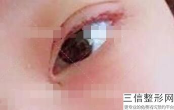 做去眼袋大概多少钱,做去眼袋一般多少钱