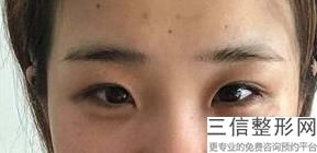 做去眼袋大概价格，去眼袋整形的价格
