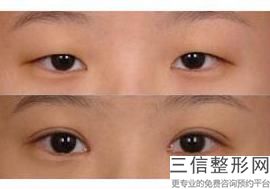 做去眼袋的价钱是多少，做个去眼袋要多少钱