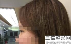 做双眼皮大概要需要多少钱，一般做双眼皮大概多少钱