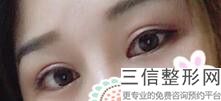 做双眼皮好多钱好西安伊美尔怎么走，做双眼皮好多钱好西安伊美尔怎么样