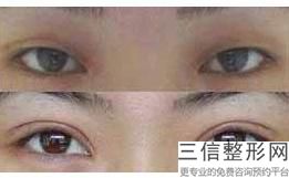 做双眼皮好看么，做双眼皮真的好吗