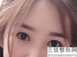 做双眼皮好吗，做双眼皮好看么