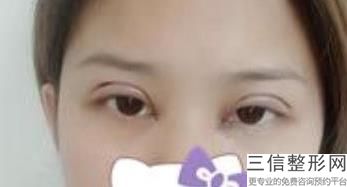 做双眼皮好吗，做双眼皮好看么