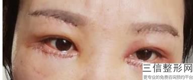 做双眼皮开眼角好不好看，有双眼皮开眼角还需要做双眼皮吗