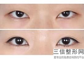 做双眼皮开眼角怎样恢复快，有双眼皮开眼角还需要做双眼皮吗