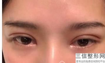 做双眼皮哪儿好，哪里做双眼皮比较好有知道的吗