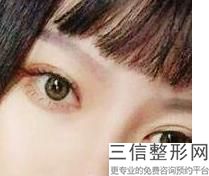 做双眼皮哪儿好，哪里做双眼皮比较好有知道的吗