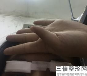 做双眼皮什么方法好，双眼皮如何做好