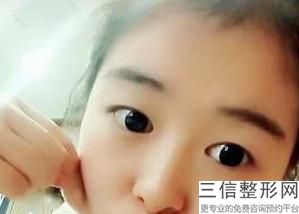 做双眼皮手术的方法有哪些，双眼皮手术步骤