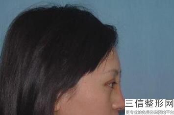 做双眼皮手术多少钱啊，割双眼皮整形要多少钱