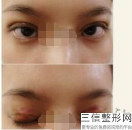 做双眼皮手术好吗，双眼皮能做双眼皮手术吗