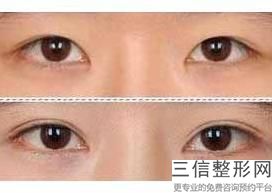 做双眼皮手术好吗，双眼皮能做双眼皮手术吗