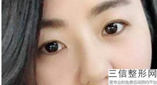 做双眼皮手术会失败吗，做双眼皮失败的