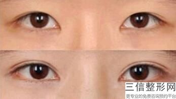 做双眼皮手术前准备什么，做双眼皮术前准备工作