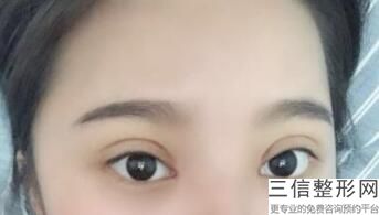 做双眼皮手术前准备什么，做双眼皮术前准备工作