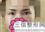 做双眼皮修复多少钱啊，修复双眼皮大概多少钱