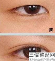 做双眼皮修复要多少钱，做修复双眼皮手术需要多少钱