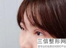 做双眼皮需要多长时间能好,做双眼皮得多久