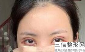 做双眼皮医院哪里好，哪个医院做双眼皮好