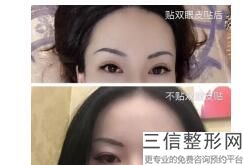 做双眼皮怎么收费,双眼皮手术在线咨询