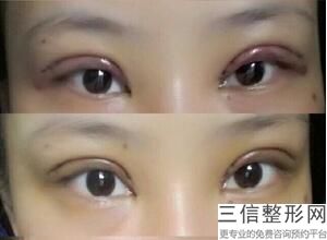 做双眼皮良好的医院，国内做双眼皮比较好的医院