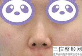 做完隆鼻手术后多久可以同房，做完隆鼻手术后多久过感染期
