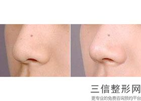 做完隆鼻手术后眼睛青肿，做完隆鼻手术后眼睛肿的厉害的图片