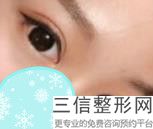 做压双眼皮手术哪里好,双眼皮割的好还是压的好