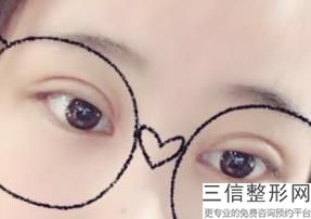 做一个双眼皮手术要多少钱，做双眼皮手术费多少