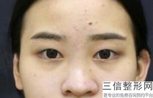做一只双眼皮大概多少钱，做一只眼睛双眼皮多少钱