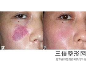 重庆哪里可以做拉皮手术,2022重庆 军美 整形医院不容错过