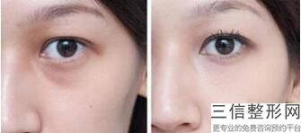 重庆双眼皮医生排行榜被胡金香,2022申霄医生实力超强