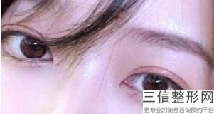重庆双眼皮做的好的医生有哪些,2022刘林奇医生实力非凡