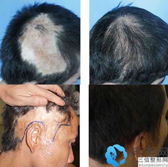 重庆植发正规医院排名前三有哪些,2022重庆新沐医疗美容医院锁定前十