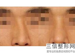 重庆做鼻子医生排名榜有杜亚旭,2022 【彭绍宗】主任医师实力入围
