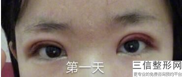 重庆做双眼皮整形医院排名,2022重庆华美整形医院实力超强