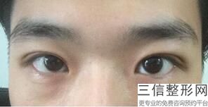 做修复双眼皮好的医院排行表大全,2022上海九院整形科遥遥领先